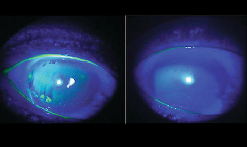 mississauga oakville dry eye treatment before after